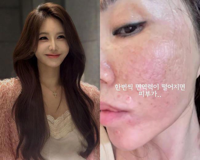 강예빈 얼굴 피부 트러블