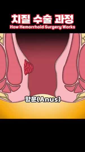 치질을 치료 하는 법.mp4