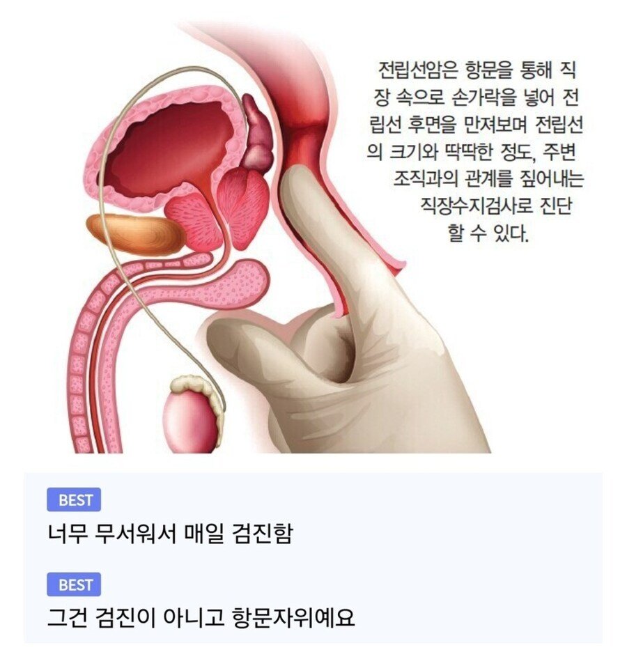 전립선암 진단하는 방법.