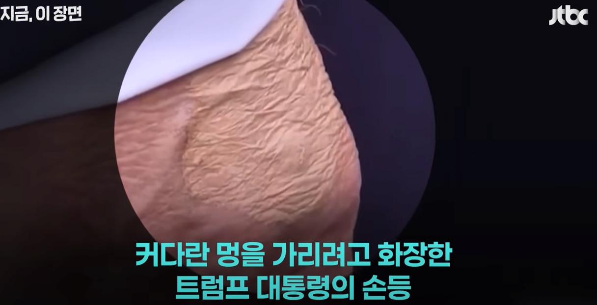 현재, 트럼프 대통령 손 상태