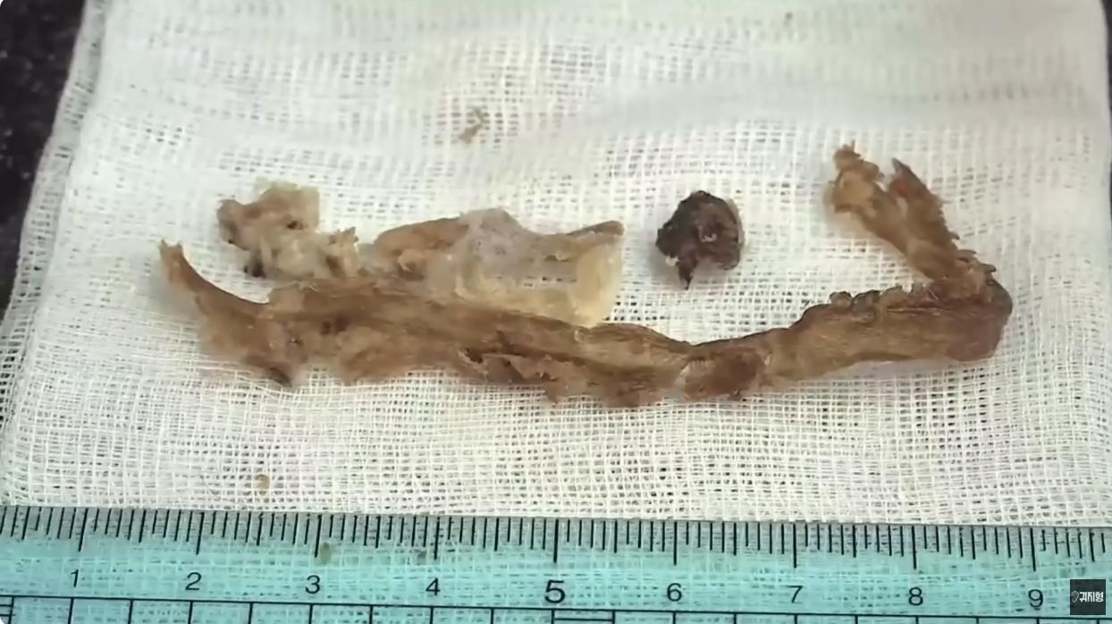 (약혐) 귀지 제거 영상 중 가장 거대한 귀지